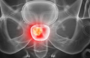 🔒 Prostatakarzinom: Die fokale Therapie eignet sich nicht als Standard