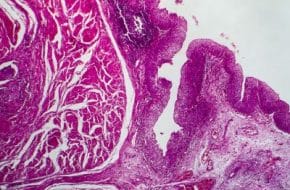 🔒 Uroonkologie: Organerhalt bei Tumoren des oberen Harntrakts