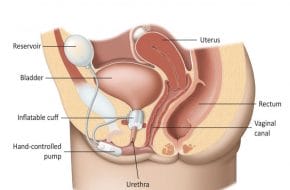 🔒 Therapie der weiblichen Belastungsharninkontinenz mit artifiziellem Sphinkter