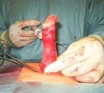 🔒 Induratio penis plastica: Der State of the Art der operativen Therapie