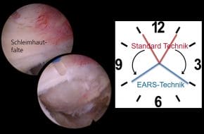 🔒 Einfluss der neuen EARS-Technik während der HoLEP auf die frühe Kontinenz